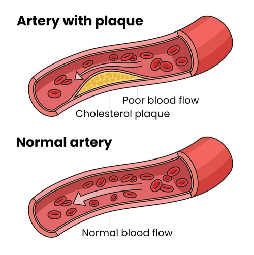 Illustration showing a normal artery with blood flowing and a partially blocked artery with less blood flow. 