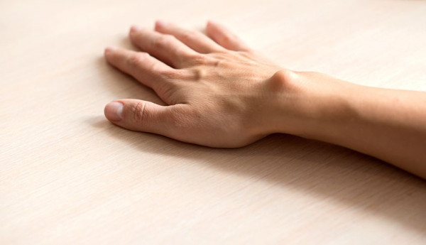 Photograph of a ganglion cyst on the back of the wrist.